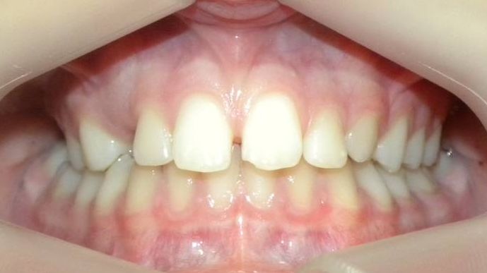 Frontal (Oclusión)