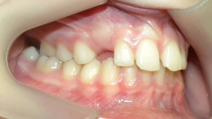 Lateral Derecha