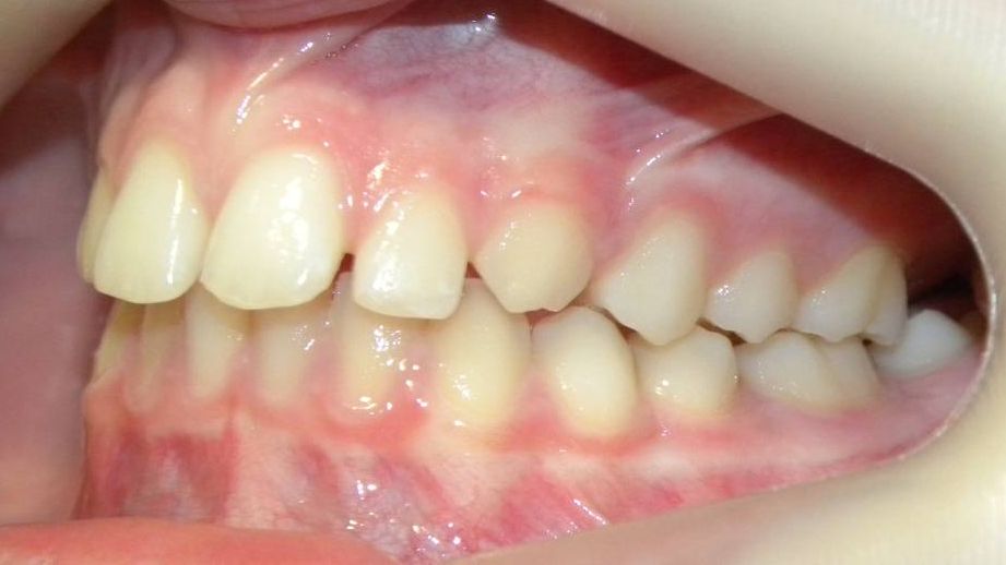 Lateral Izquierda