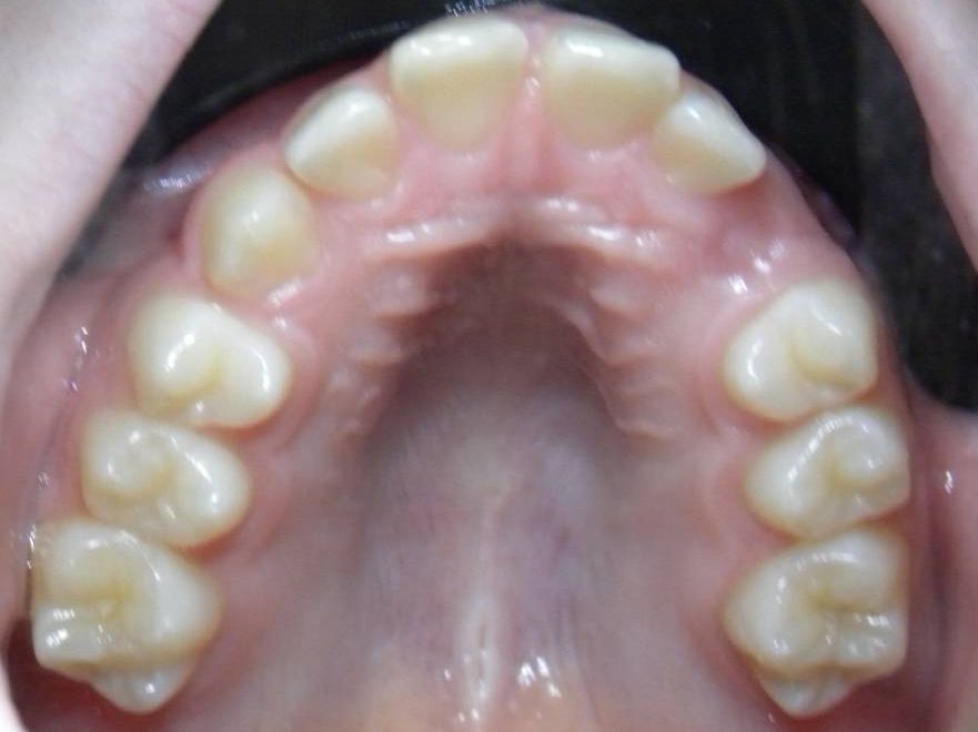 Oclusal Superior