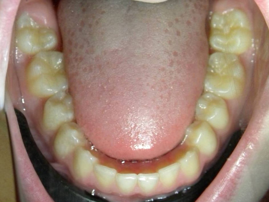 Oclusal Inferior