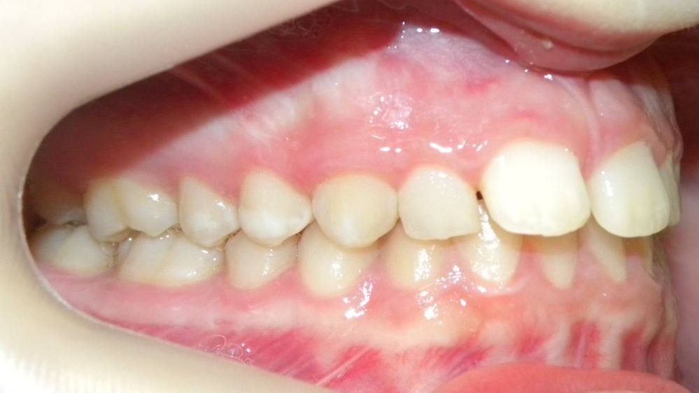 Lateral Derecha
