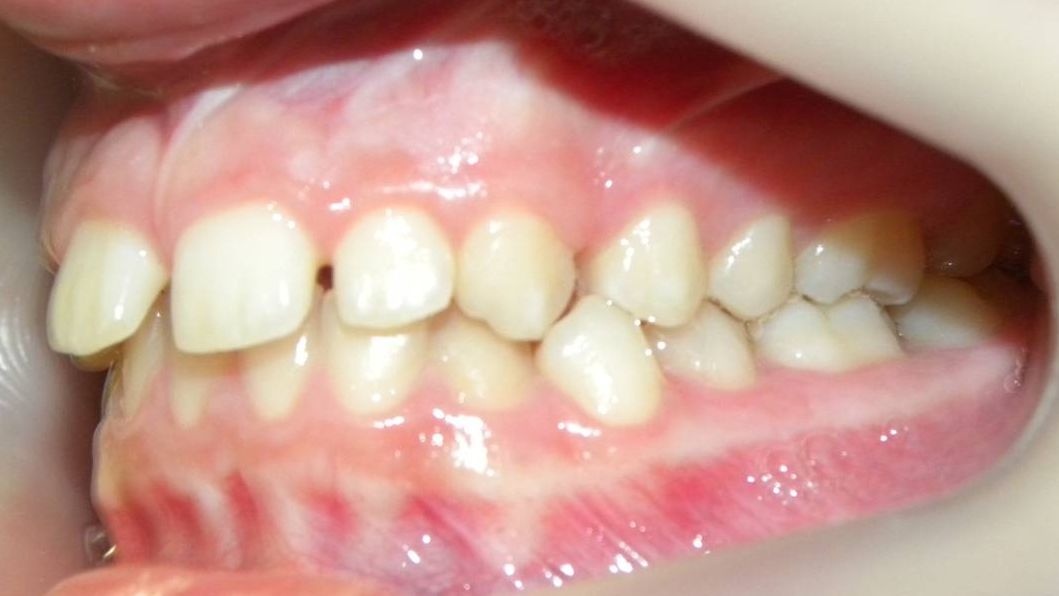 Lateral Izquierda