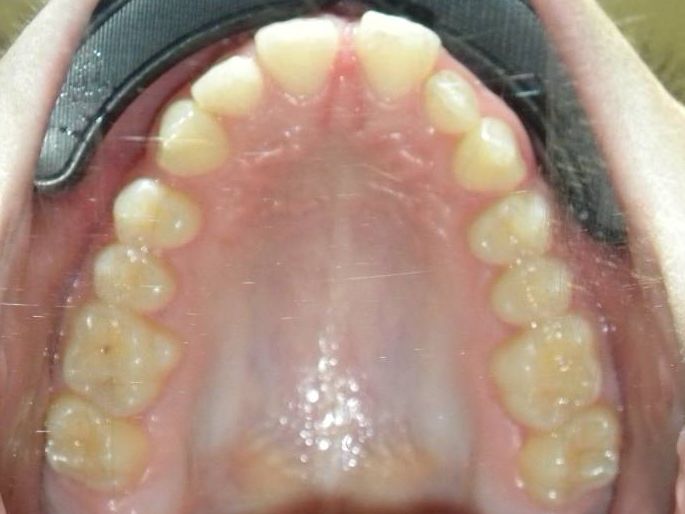 Oclusal Superior
