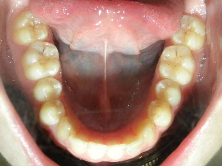 Oclusal Inferior