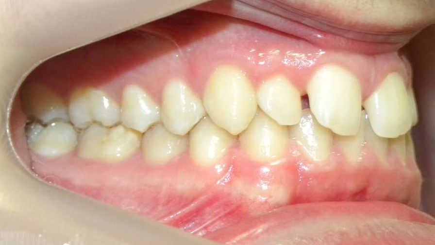 Lateral Derecha