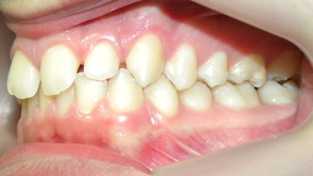 Lateral Izquierda