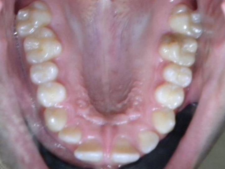 Oclusal Superior