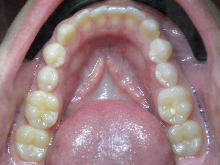 Oclusal Inferior