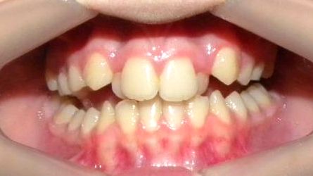 Frontal (Oclusión)