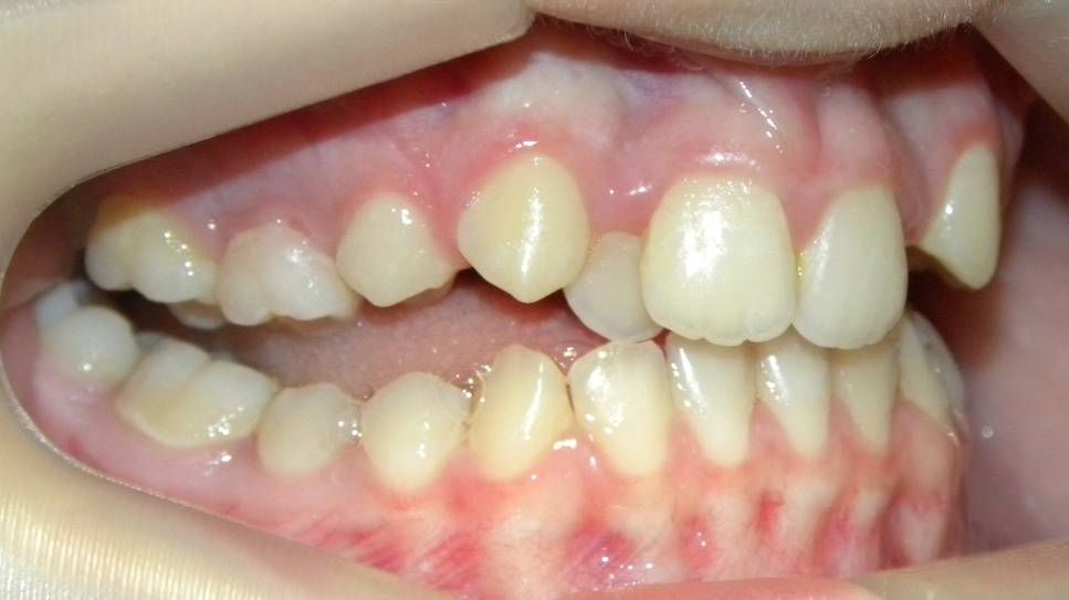 Lateral Derecha