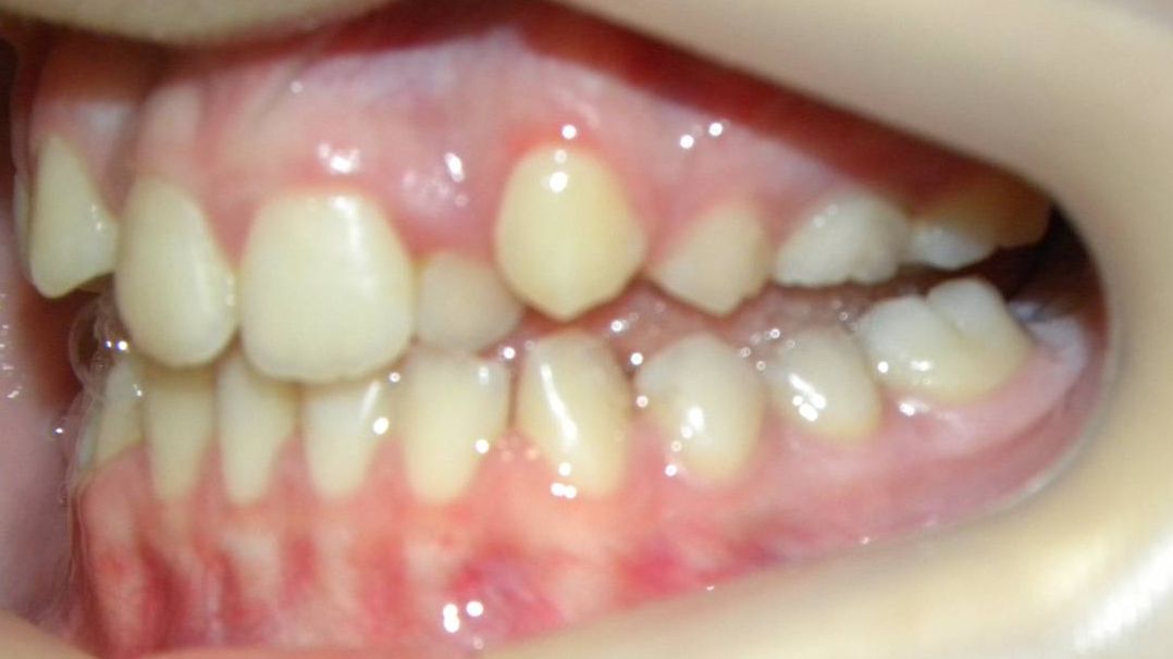 Lateral Izquierda