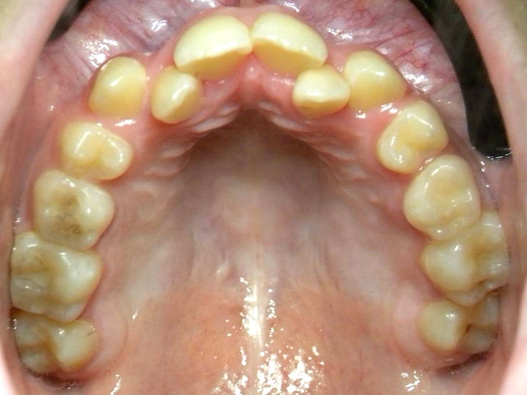 Oclusal Superior