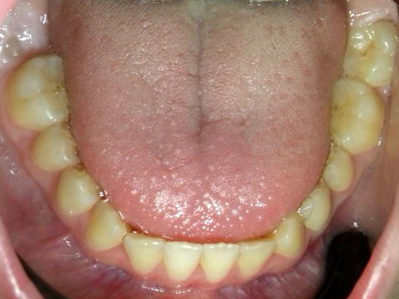 Oclusal Inferior