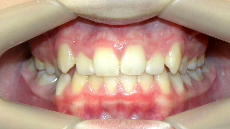 Frontal (Oclusión)