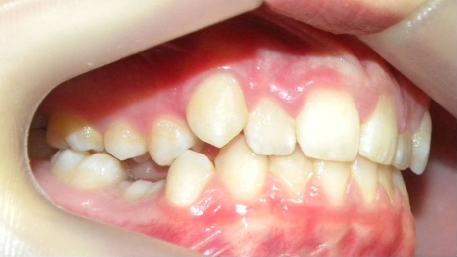 Lateral Derecha