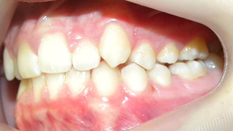 Lateral Izquierda