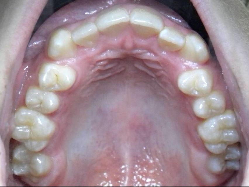 Oclusal Superior