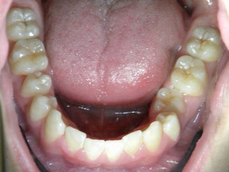 Oclusal Inferior