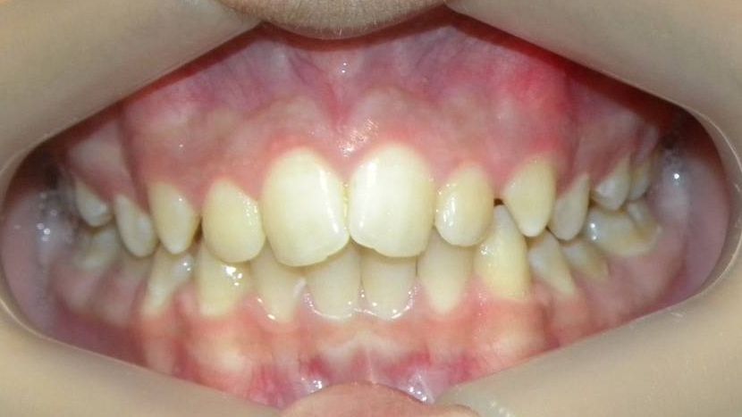 Frontal (Oclusión)