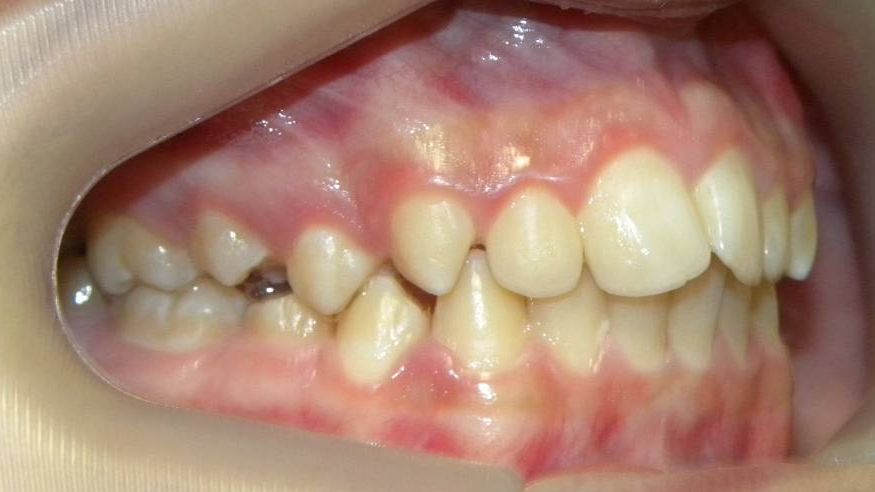 Lateral Derecha