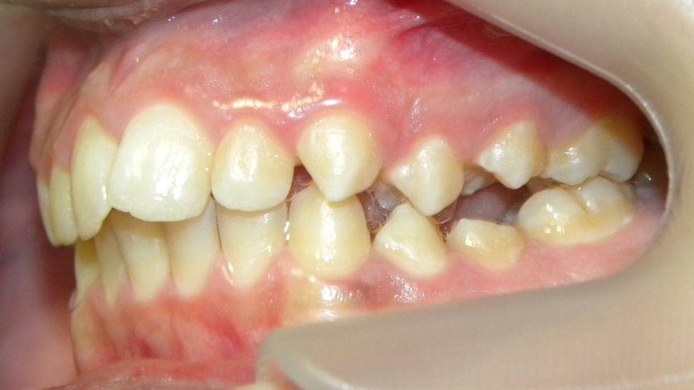 Lateral Izquierda