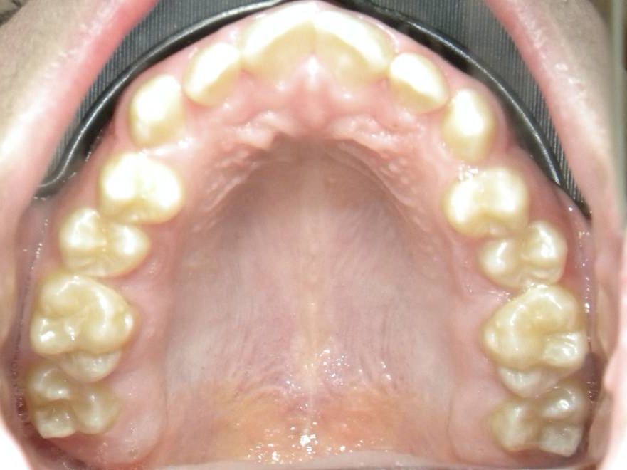 Oclusal Superior