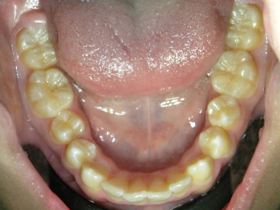Oclusal Inferior