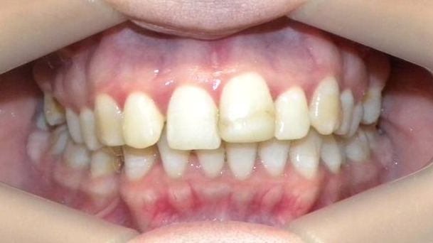 Frontal (Oclusión)