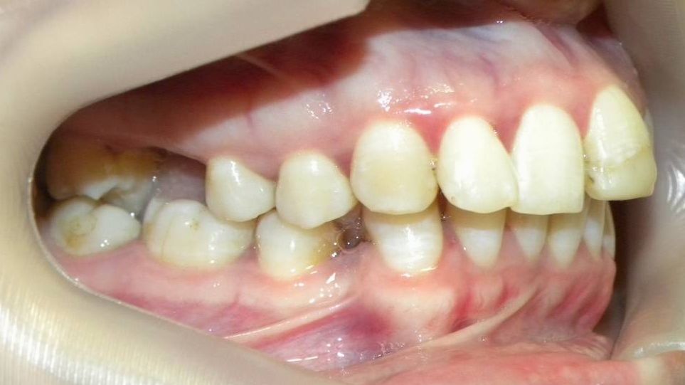 Lateral Derecha