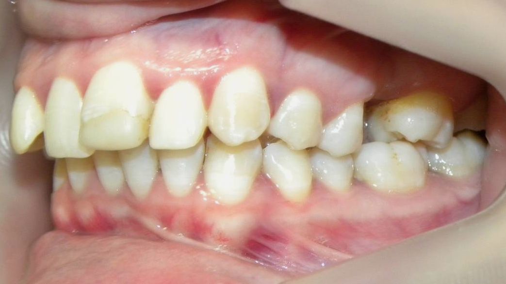 Lateral Izquierda