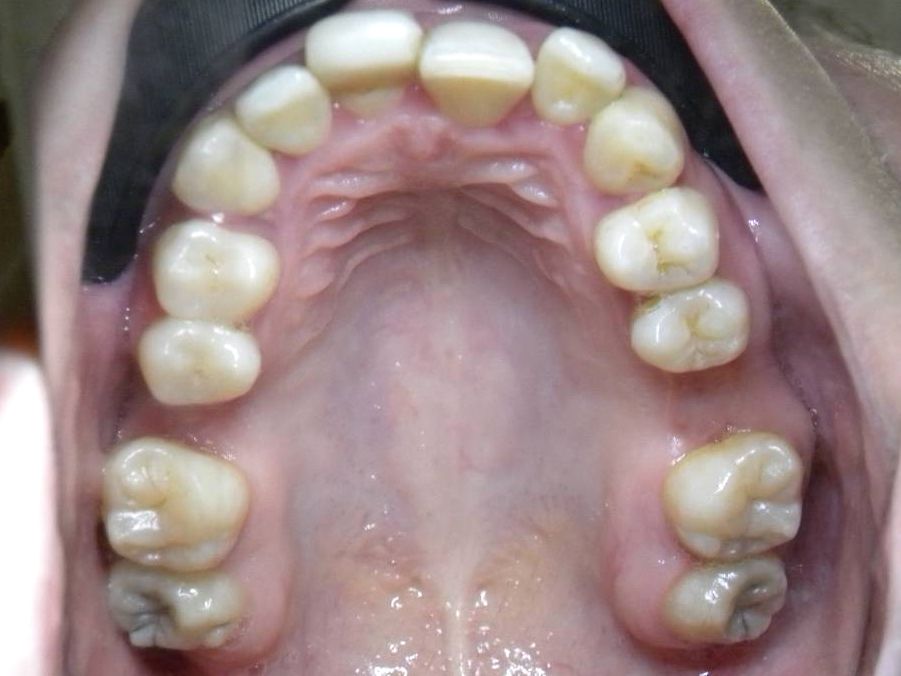 Oclusal Superior