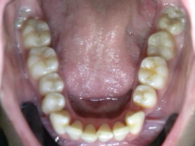Oclusal Inferior