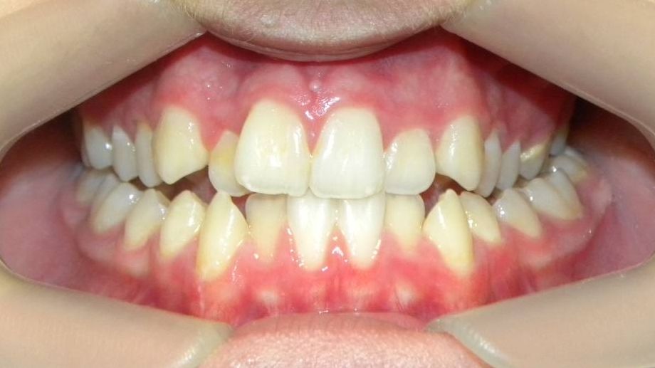 Frontal (Oclusión)
