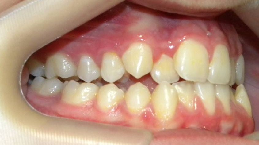 Lateral Derecha