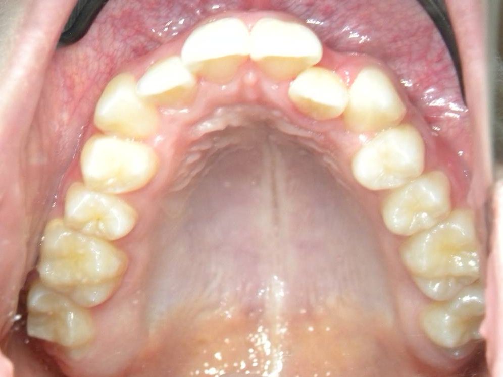 Oclusal Superior