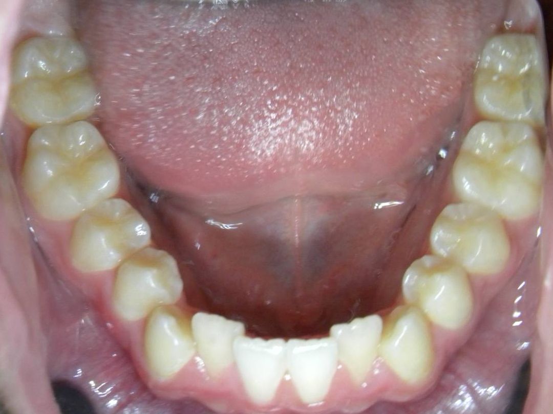 Oclusal Inferior