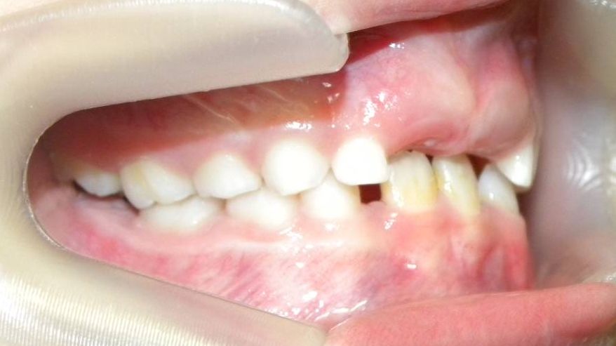 Lateral Derecha