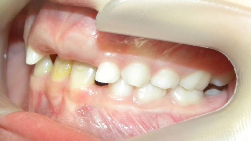 Lateral Izquierda