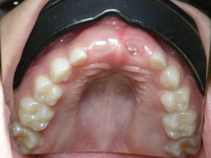 Oclusal Superior