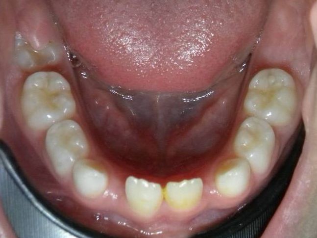 Oclusal Inferior