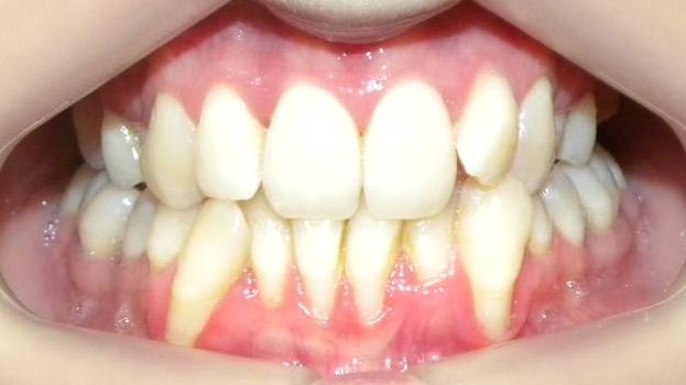 Frontal (Oclusión)