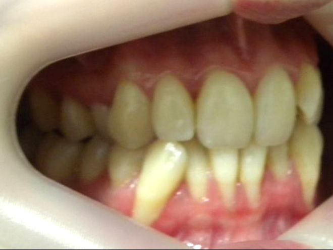 Lateral Derecha