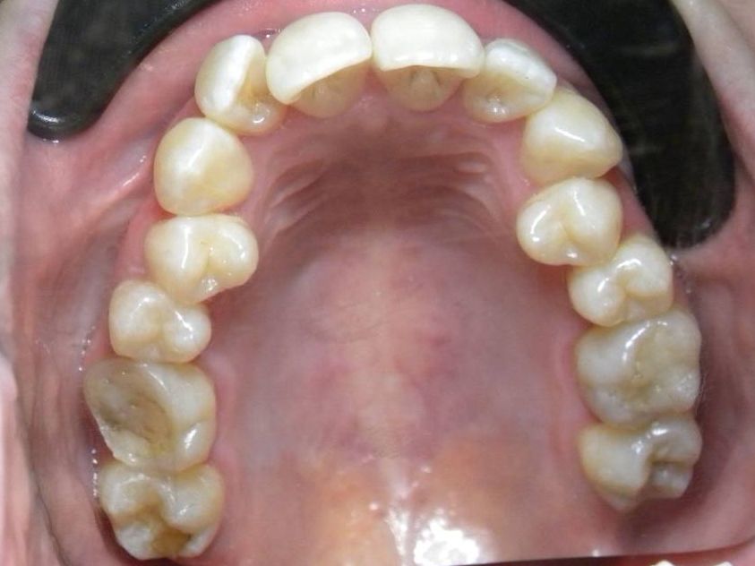 Oclusal Superior