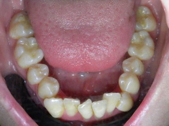 Oclusal Inferior