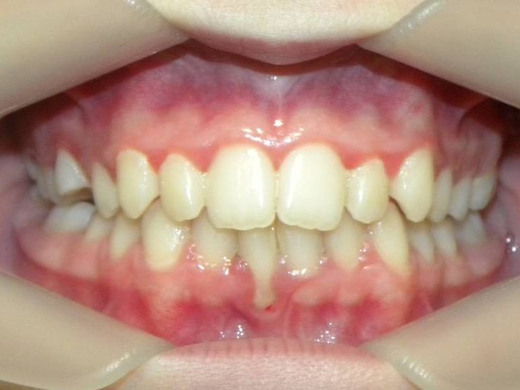 Frontal (Oclusión)