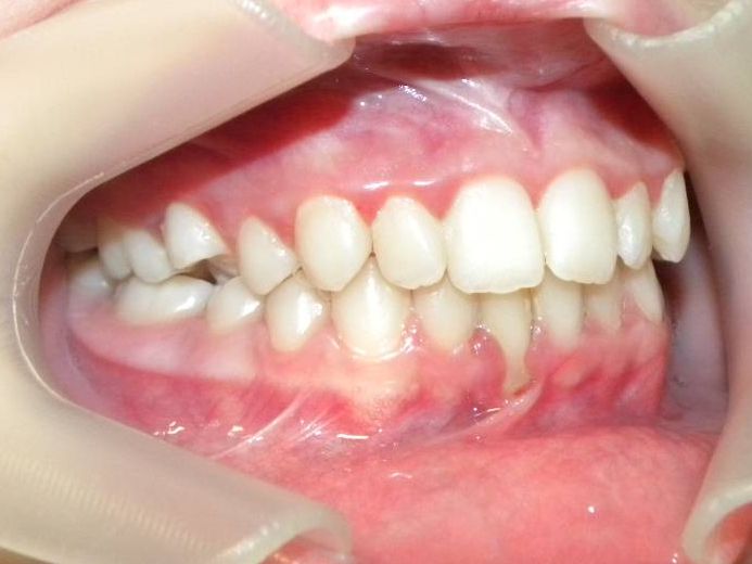 Lateral Derecha