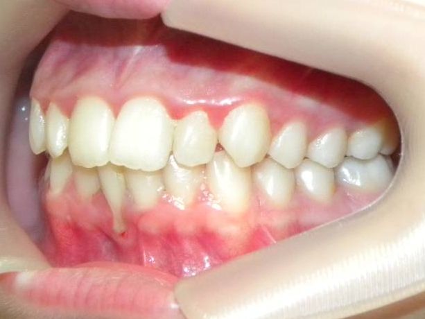 Lateral Izquierda