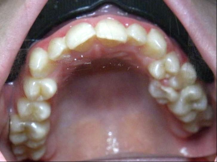 Oclusal Superior