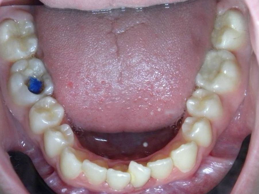 Oclusal Inferior